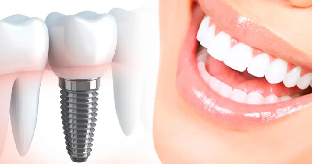 Implante-dental-Republica-Dominicana