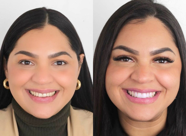 carillas-dentales-en-santiago