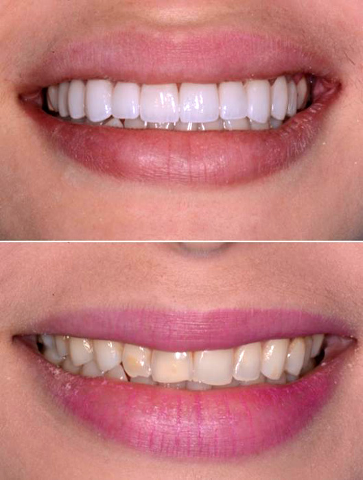 implantes-dentales-ivodontix-republica-dominicana